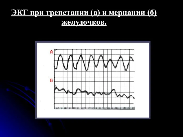 ЭКГ при трепетании (а) и мерцании (б) желудочков.