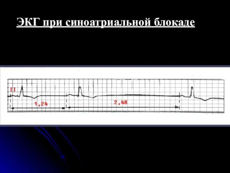 ЭКГ при синоатриальной блокаде