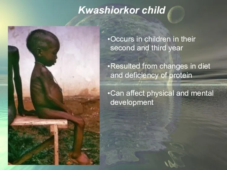 Kwashiorkor child Occurs in children in their second and third year Resulted