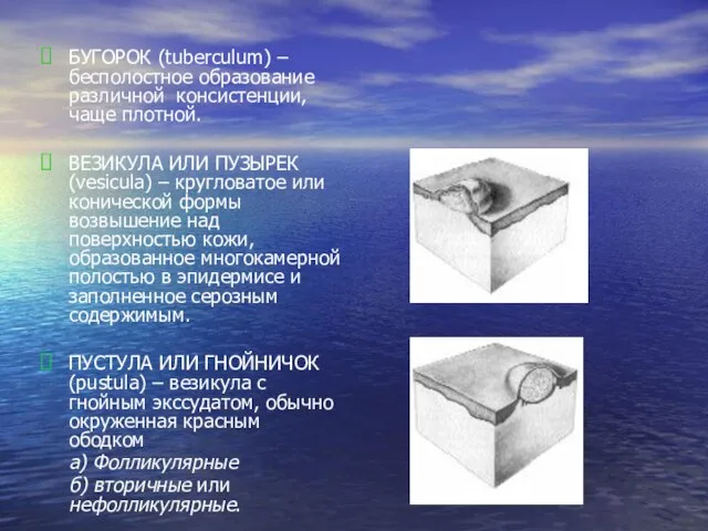 БУГОРОК (tuberculum) – бесполостное образование различной консистенции, чаще плотной. ВЕЗИКУЛА ИЛИ ПУЗЫРЕК