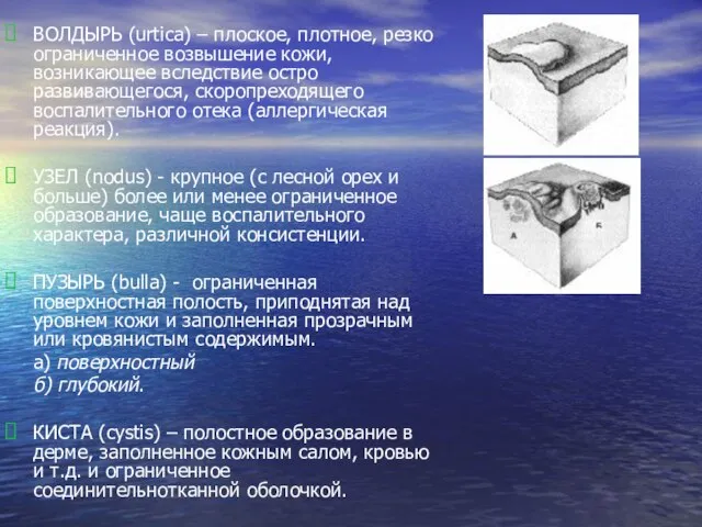 ВОЛДЫРЬ (urtica) – плоское, плотное, резко ограниченное возвышение кожи, возникающее вследствие остро