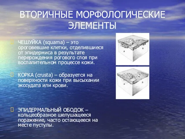 ВТОРИЧНЫЕ МОРФОЛОГИЧЕСКИЕ ЭЛЕМЕНТЫ ЧЕШУЙКА (squama) – это ороговевшие клетки, отделившиеся от эпидермиса