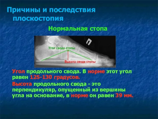 Нормальная стопа Причины и последствия плоскостопия Угол продольного свода. В норме этот