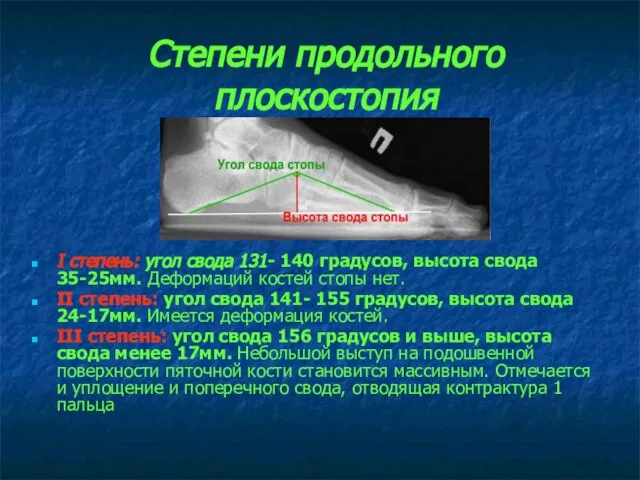 Степени продольного плоскостопия I степень: угол свода 131- 140 градусов, высота свода