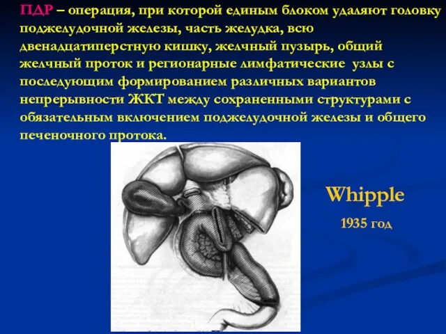 ПДР – операция, при которой единым блоком удаляют головку поджелудочной железы, часть