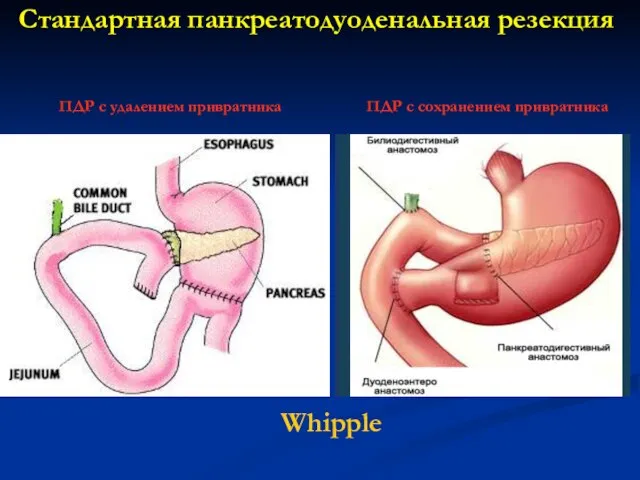 Стандартная панкреатодуоденальная резекция ПДР с сохранением привратника ПДР с удалением привратника Whipple