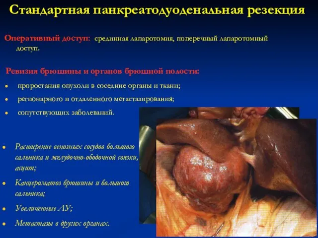 Стандартная панкреатодуоденальная резекция Оперативный доступ: срединная лапаротомия, поперечный лапаротомный доступ. Ревизия брюшины