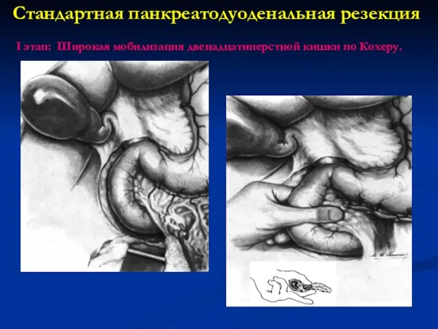 Стандартная панкреатодуоденальная резекция I этап: Широкая мобилизация двенадцатиперстной кишки по Кохеру.