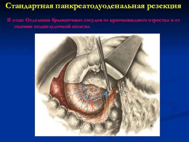 Стандартная панкреатодуоденальная резекция II этап: Отделение брыжеечных сосудов от крючковидного отростка и от головки поджелудочной железы.