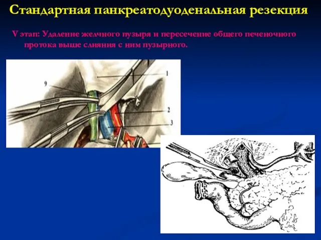 Стандартная панкреатодуоденальная резекция V этап: Удаление желчного пузыря и пересечение общего печеночного