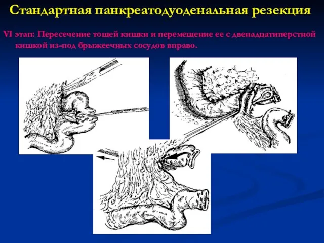 VI этап: Пересечение тощей кишки и перемещение ее с двенадцатиперстной кишкой из-под