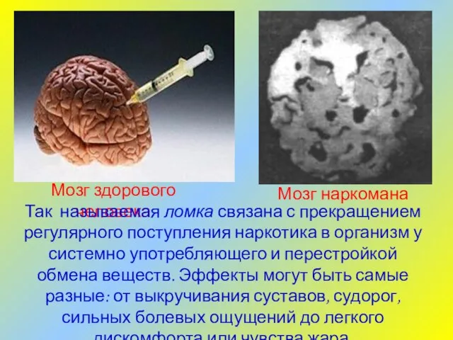 Мозг наркомана Мозг здорового человека Так называемая ломка связана с прекращением регулярного