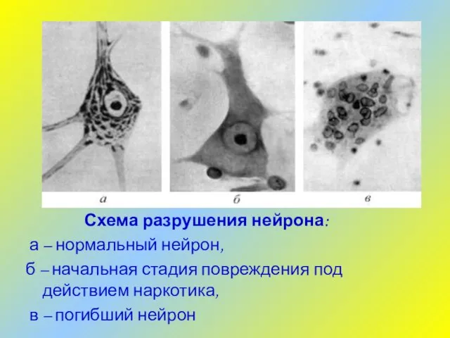 Схема разрушения нейрона: а – нормальный нейрон, б – начальная стадия повреждения