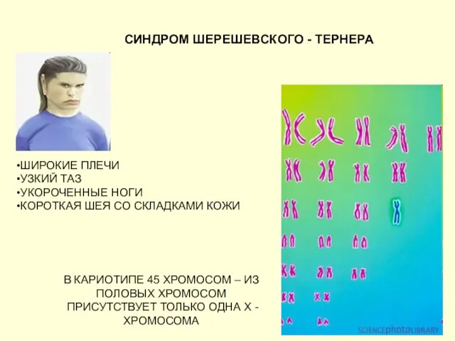 СИНДРОМ ШЕРЕШЕВСКОГО - ТЕРНЕРА В КАРИОТИПЕ 45 ХРОМОСОМ – ИЗ ПОЛОВЫХ ХРОМОСОМ