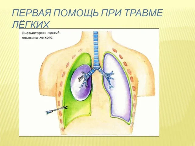 Первая помощь при травме лёгких