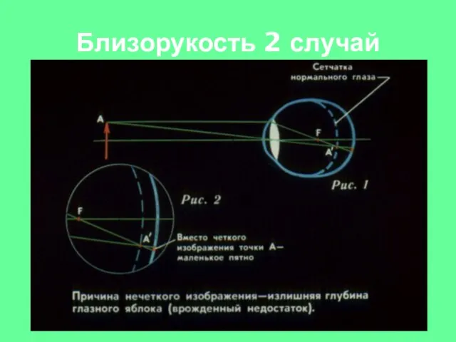 Близорукость 2 случай