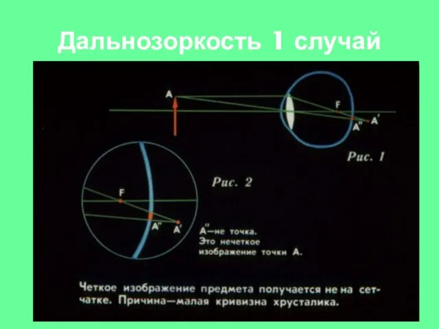 Дальнозоркость 1 случай