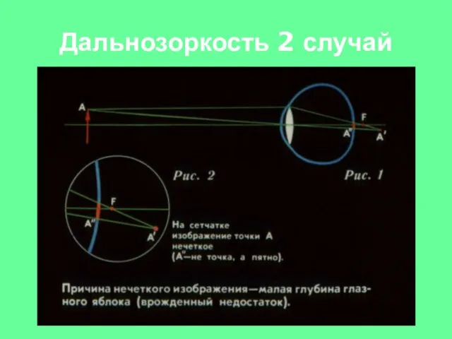 Дальнозоркость 2 случай