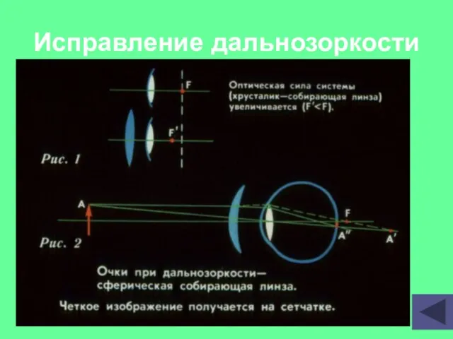 Исправление дальнозоркости