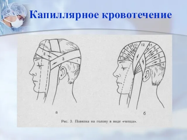 Капиллярное кровотечение