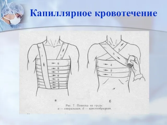 Капиллярное кровотечение