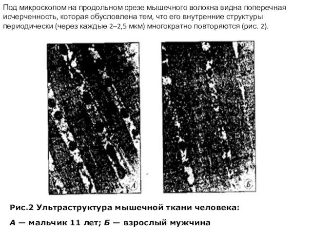 Рис.2 Ультраструктура мышечной ткани человека: А — мальчик 11 лет; Б —