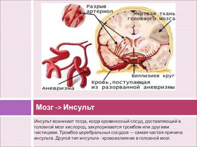 Инсульт возникает тогда, когда кровеносный сосуд, доставляющий в головной мозг кислород, закупоривается