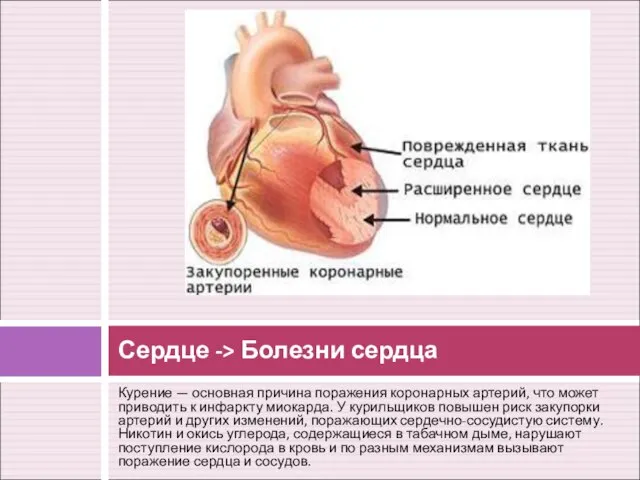 Курение — основная причина поражения коронарных артерий, что может приводить к инфаркту