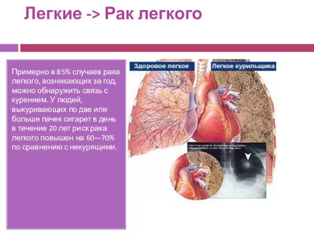 Легкие -> Рак легкого Примерно в 85% случаев рака легкого, возникающих за