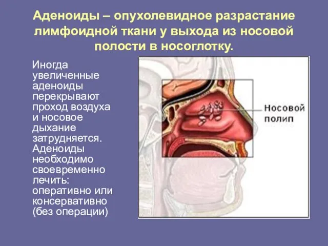 Аденоиды – опухолевидное разрастание лимфоидной ткани у выхода из носовой полости в