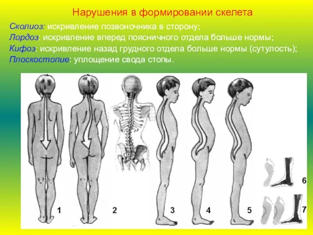 Сколиоз: искривление позвоночника в сторону; Лордоз: искривление вперед поясничного отдела больше нормы;