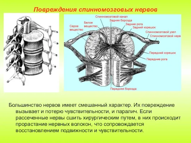 Повреждения спинномозговых нервов Большинство нервов имеет смешанный характер. Их повреждение вызывает и