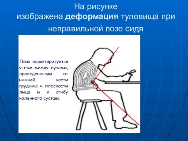 На рисунке изображена деформация туловища при неправильной позе сидя