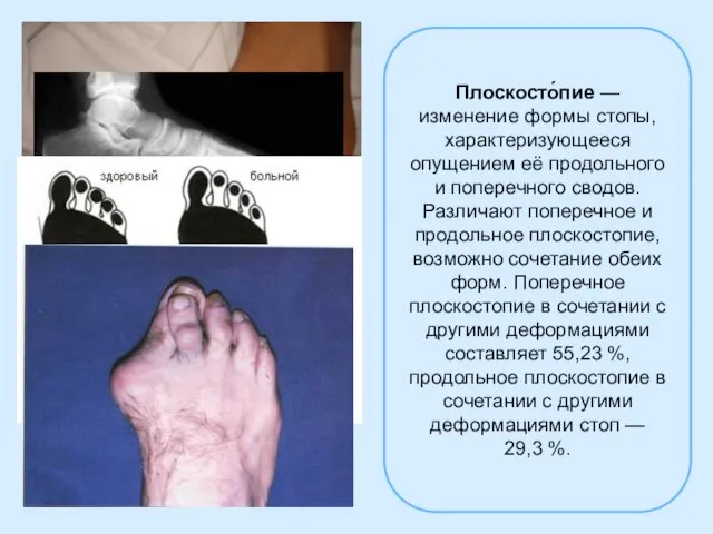 Плоскосто́пие — изменение формы стопы, характеризующееся опущением её продольного и поперечного сводов.