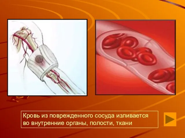 Кровь из поврежденного сосуда изливается во внутренние органы, полости, ткани