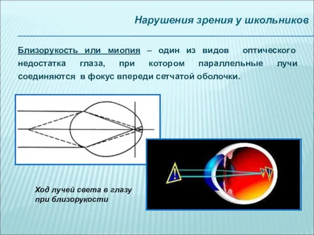 Нарушения зрения у школьников Близорукость или миопия – один из видов оптического