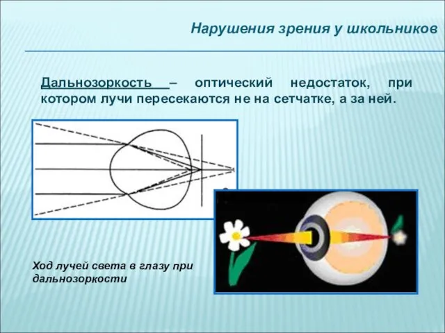 Нарушения зрения у школьников Дальнозоркость – оптический недостаток, при котором лучи пересекаются