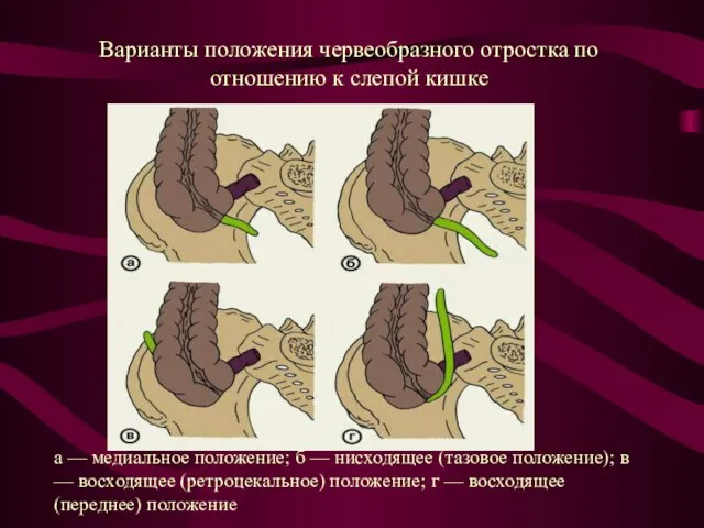 Варианты положения червеобразного отростка по отношению к слепой кишке а — медиальное