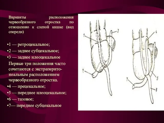 Варианты расположения червеобразного отростка по отношению к слепой кишке (вид спереди) 1