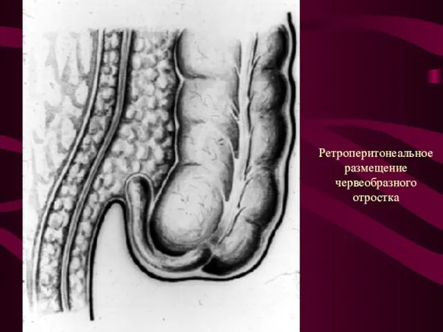 Ретроперитонеальное размещение червеобразного отростка