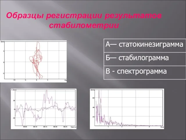 Образцы регистрации результатов стабилометрии