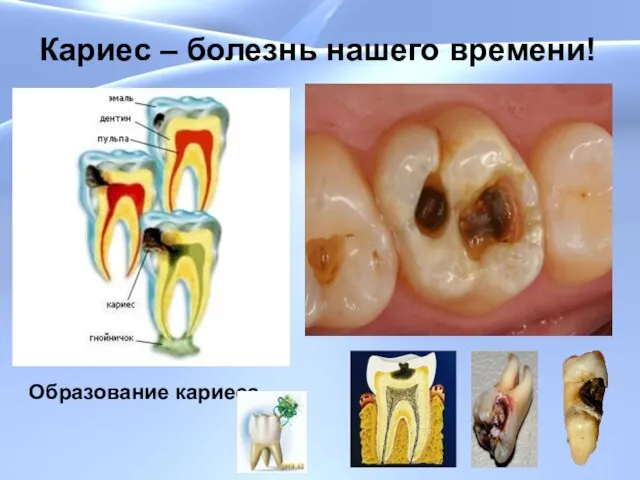 Кариес – болезнь нашего времени! Кариес – болезнь нашего времени! Образование кариеса