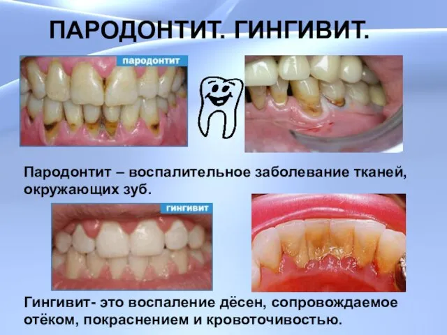 ПАРОДОНТИТ. ГИНГИВИТ. ПАРОДОНТИТ. ГИНГИВИТ. Пародонтит – воспалительное заболевание тканей, окружающих зуб. Гингивит-