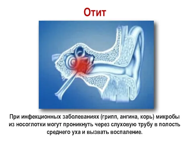 Отит При инфекционных заболеваниях (грипп, ангина, корь) микробы из носоглотки могут проникнуть