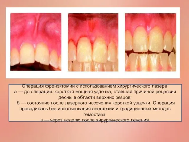 Операция френэктомии с использованием хирургического лазера: а — до операции: короткая мощная