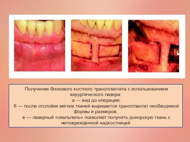 Получение блокового костного трансплантата с использованием хирургического лазера: а — вид до