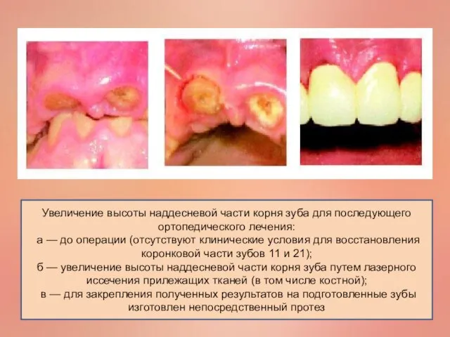 Увеличение высоты наддесневой части корня зуба для последующего ортопедического лечения: а —