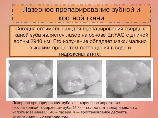 Лазерное препарирование зубной и костной ткани Сегодня оптимальным для препарирования твердых тканей