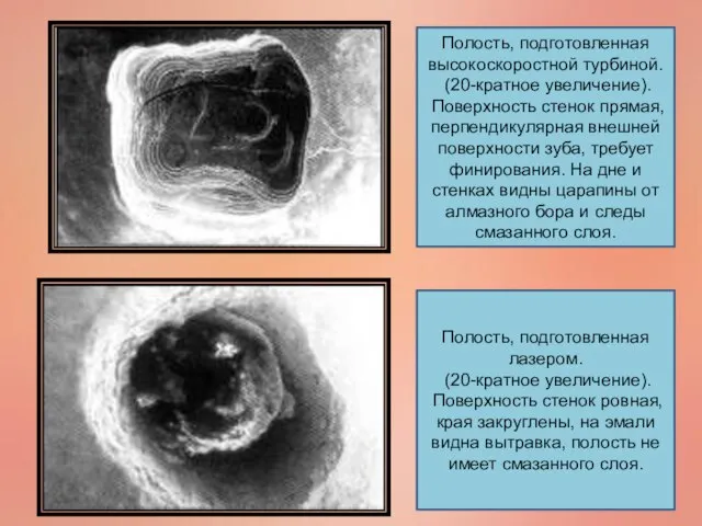 Полость, подготовленная высокоскоростной турбиной. (20-кратное увеличение). Поверхность стенок прямая, перпендикулярная внешней поверхности