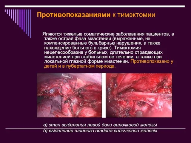 Противопоказаниями к тимэктомии Яляются тяжелые соматические заболевания пациентов, а также острая фаза